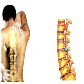 Céimeanna osteochondrosis