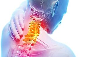 Comharthaí Osteochondrosis Ceirbheacs agus Rialacha Cothaithe le haghaidh Galair