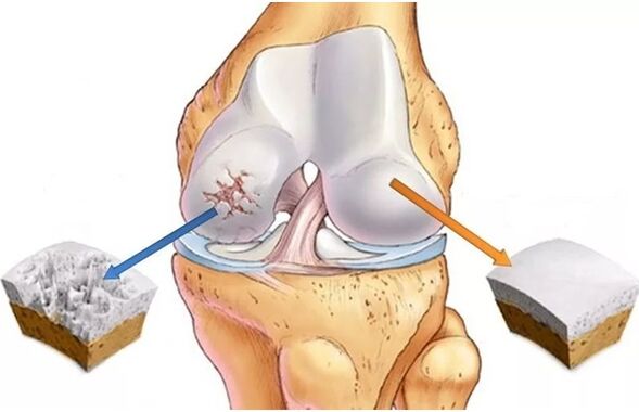 Cartilage sláintiúil agus cartilage a bhfuil airtrosis difear aige
