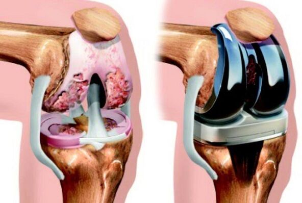 roimh agus tar éis endoprosthetics na comhpháirte glúine le airtrosis