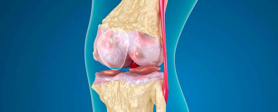 airtríteas an chomhpháirteacha glúine