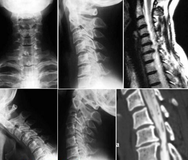 X-gha den spine ceirbheacsach chun osteochondrosis a dhiagnóisiú